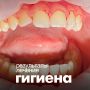 Почему профессиональная гигиена зубов жизненно важна для подростков?